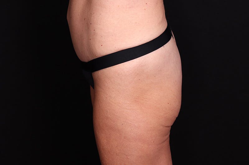 Fat Grafting to Buttock Before & After Gallery - Patient 115415 - Image 3