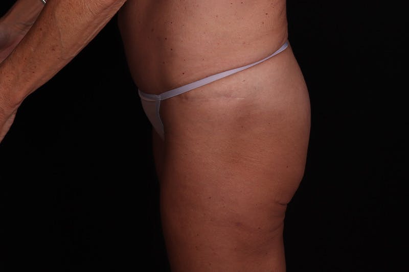 Fat Grafting to Buttock Before & After Gallery - Patient 115415 - Image 4