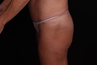 Fat Grafting to Buttock Before & After Gallery - Patient 115415 - Image 4