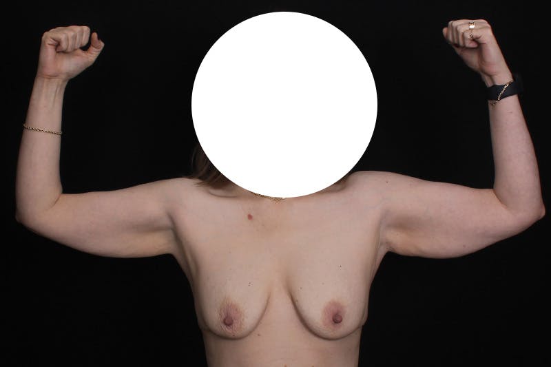 Brachioplasty Before & After Gallery - Patient 110352 - Image 1