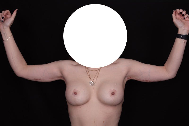 Brachioplasty Before & After Gallery - Patient 110352 - Image 2
