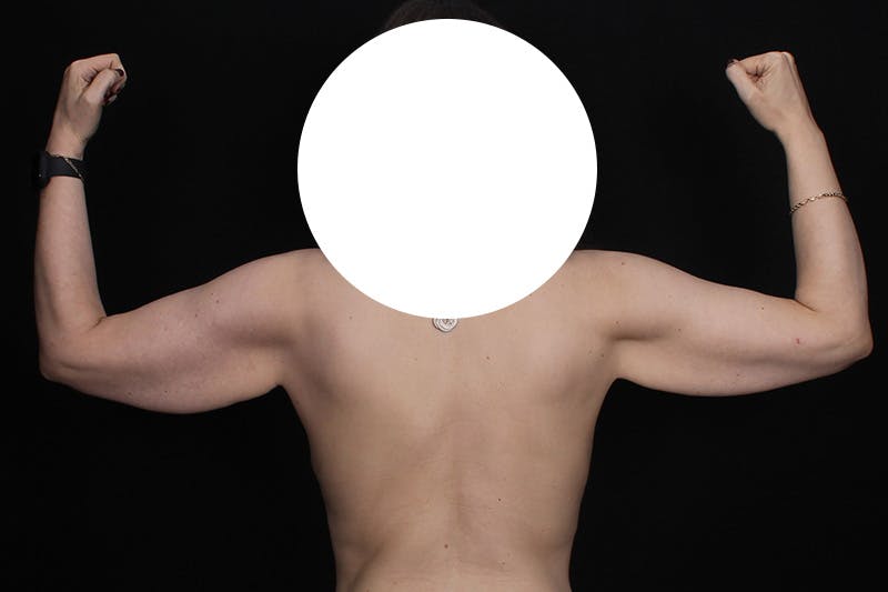 Brachioplasty Before & After Gallery - Patient 110352 - Image 3