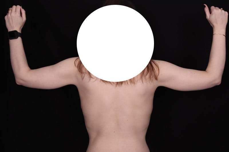Brachioplasty Before & After Gallery - Patient 110352 - Image 4