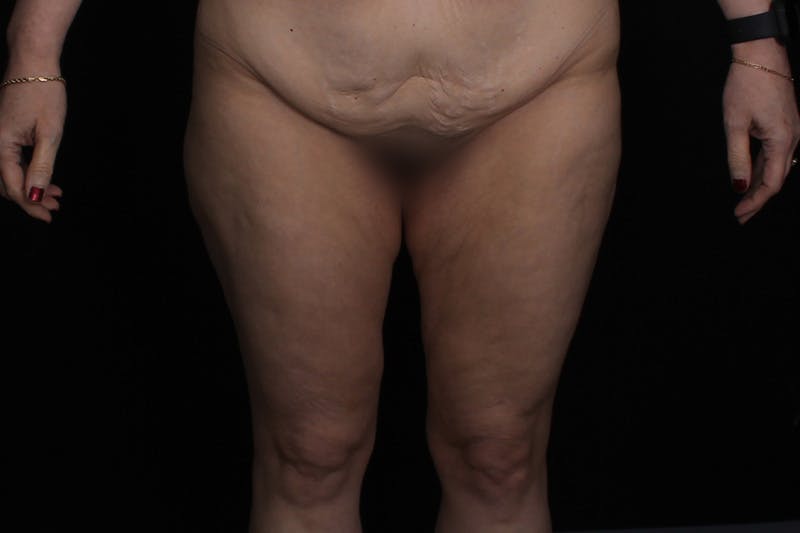 Thigh Lift Before & After Gallery - Patient 805976 - Image 1