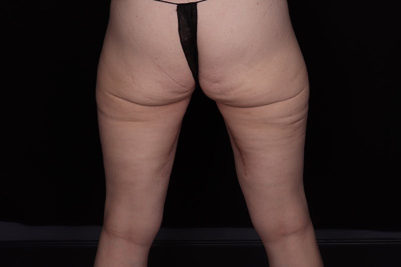 Thigh Lift Before & After Gallery - Patient 805976 - Image 4