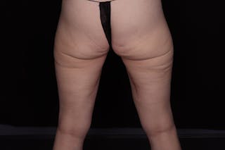 Thigh Lift Before & After Gallery - Patient 805976 - Image 4