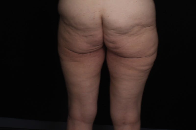 Thigh Lift Before & After Gallery - Patient 805976 - Image 3