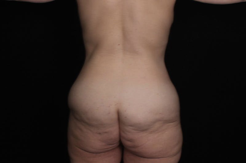 Trunk Lift Before & After Gallery - Patient 311102 - Image 1