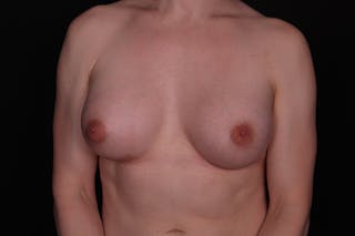 MTF Breast Augmentation Before & After Gallery - Patient 254192 - Image 2