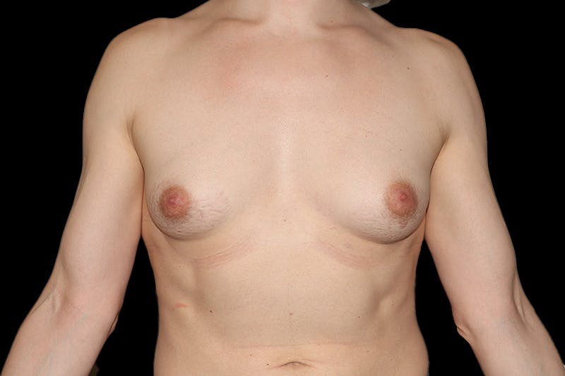MTF Breast Augmentation Before & After Gallery - Patient 254192 - Image 1