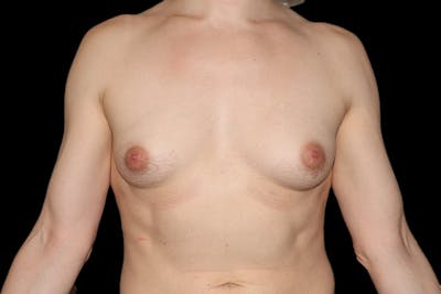 MTF Breast Augmentation Before & After Gallery - Patient 254192 - Image 1