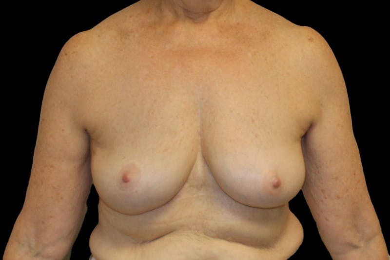 Breast Explant Before & After Gallery - Patient 335472 - Image 2