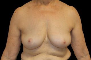 Breast Explant Before & After Gallery - Patient 335472 - Image 2
