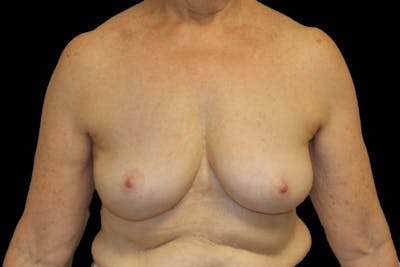Breast Explant Before & After Gallery - Patient 335472 - Image 2