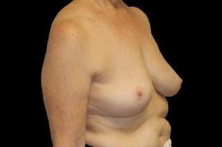 Breast Explant Before & After Gallery - Patient 335472 - Image 4