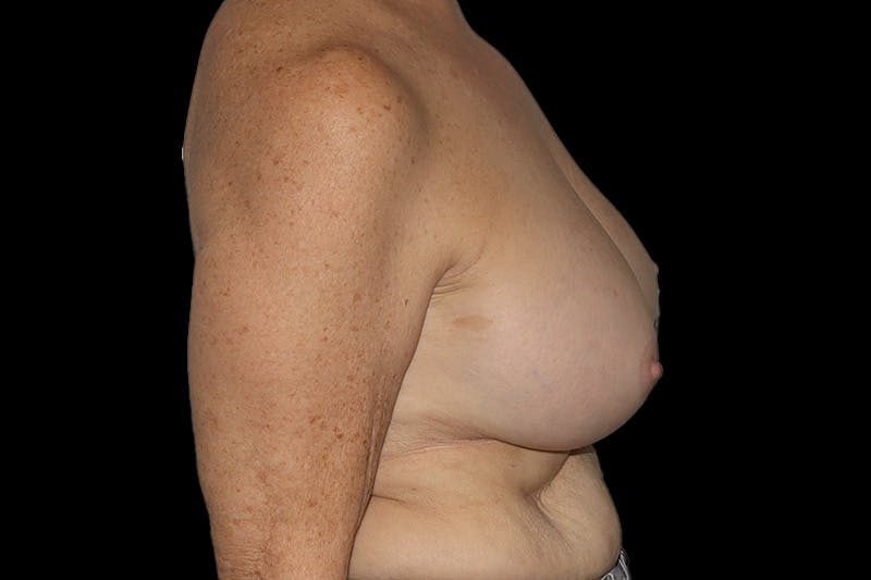 Breast Explant Before & After Gallery - Patient 335472 - Image 5