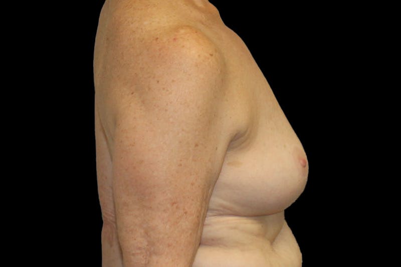 Breast Explant Before & After Gallery - Patient 335472 - Image 6