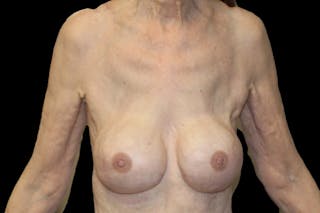 Breast Reconstruction Revision Before & After Gallery - Patient 789147 - Image 2