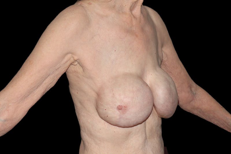 Breast Reconstruction Revision Before & After Gallery - Patient 789147 - Image 3