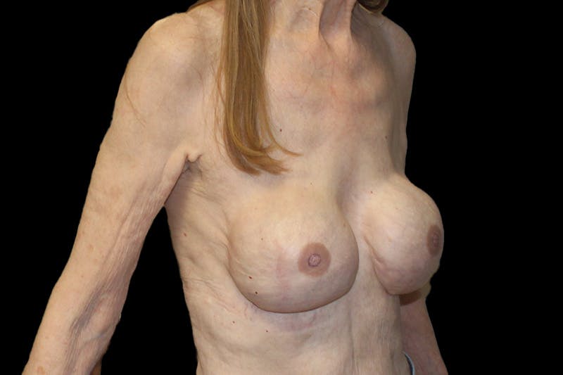 Breast Reconstruction Revision Before & After Gallery - Patient 789147 - Image 4