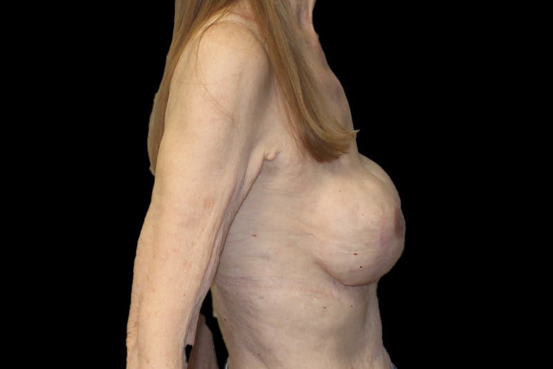 Breast Reconstruction Revision Before & After Gallery - Patient 789147 - Image 6
