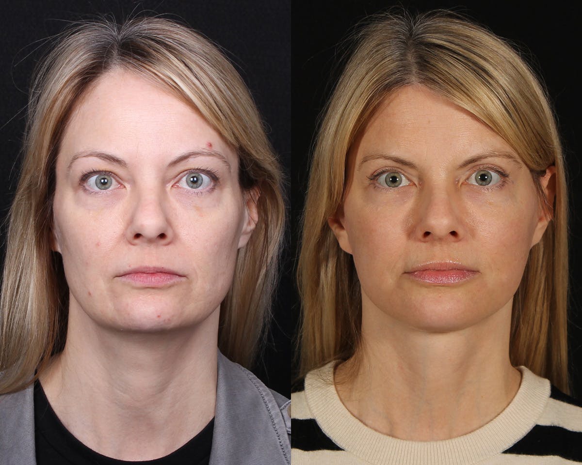 Face & Neck Lift Before & After Gallery - Patient 154632 - Image 1