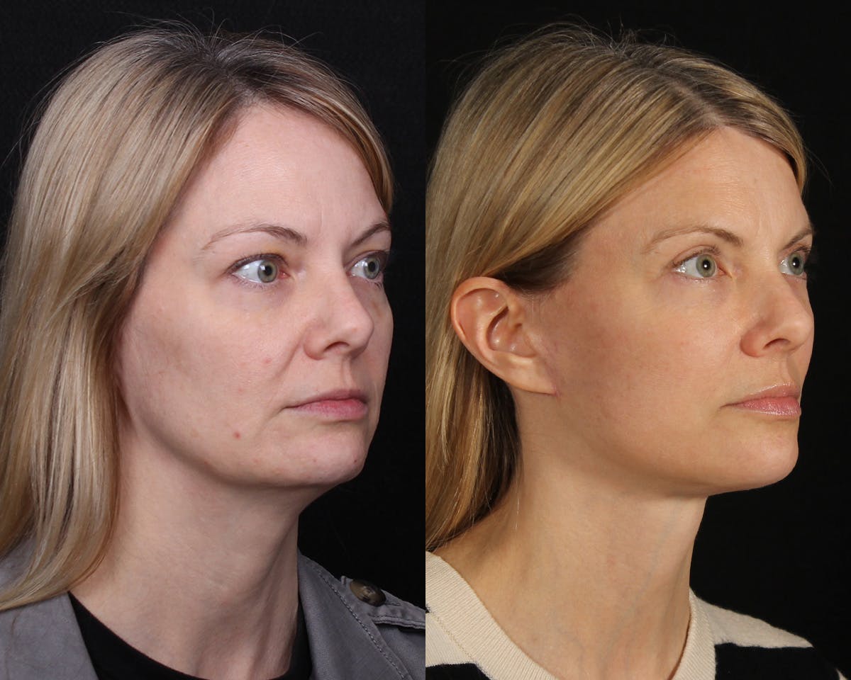 Face & Neck Lift Before & After Gallery - Patient 154632 - Image 2