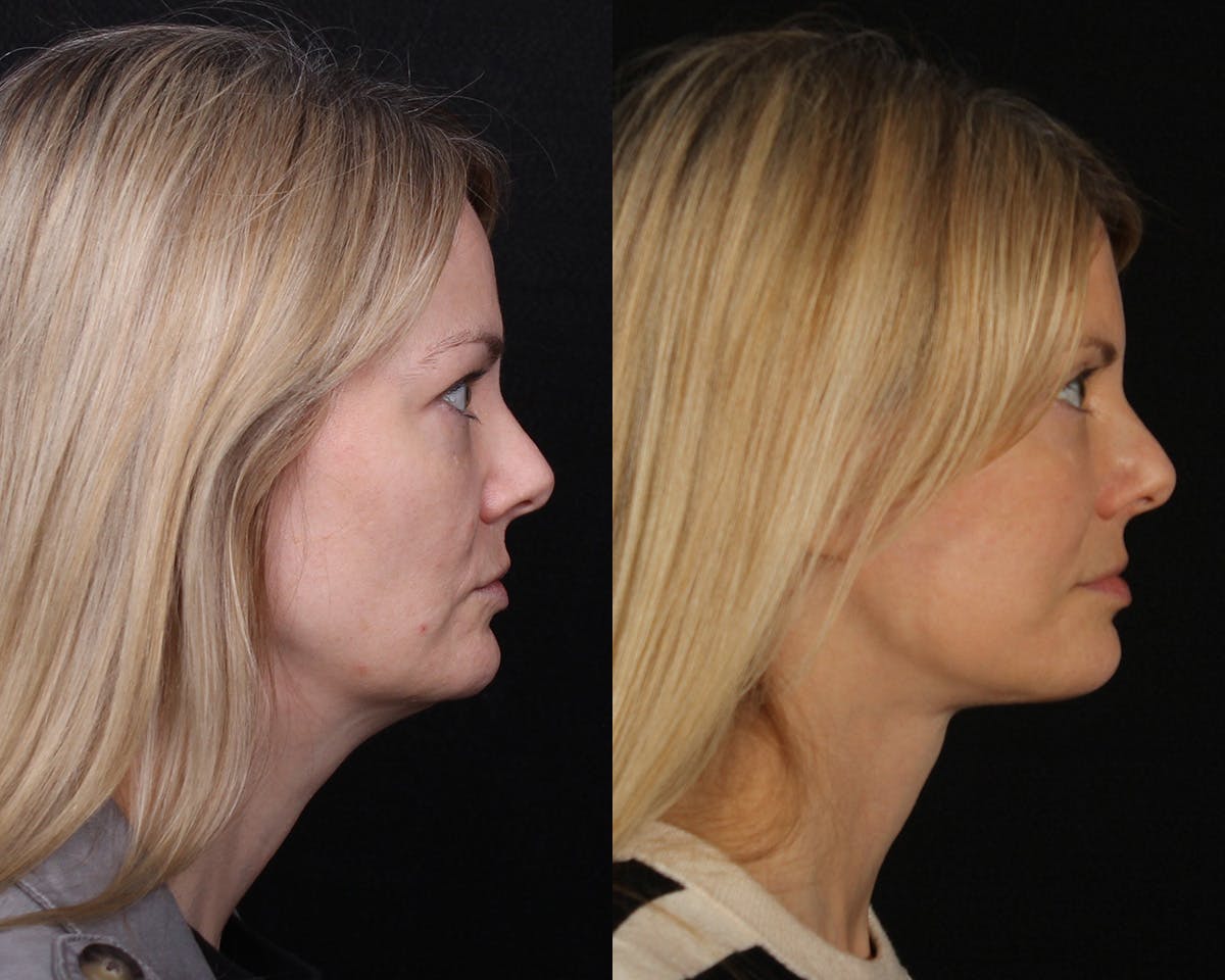 Face & Neck Lift Before & After Gallery - Patient 154632 - Image 3