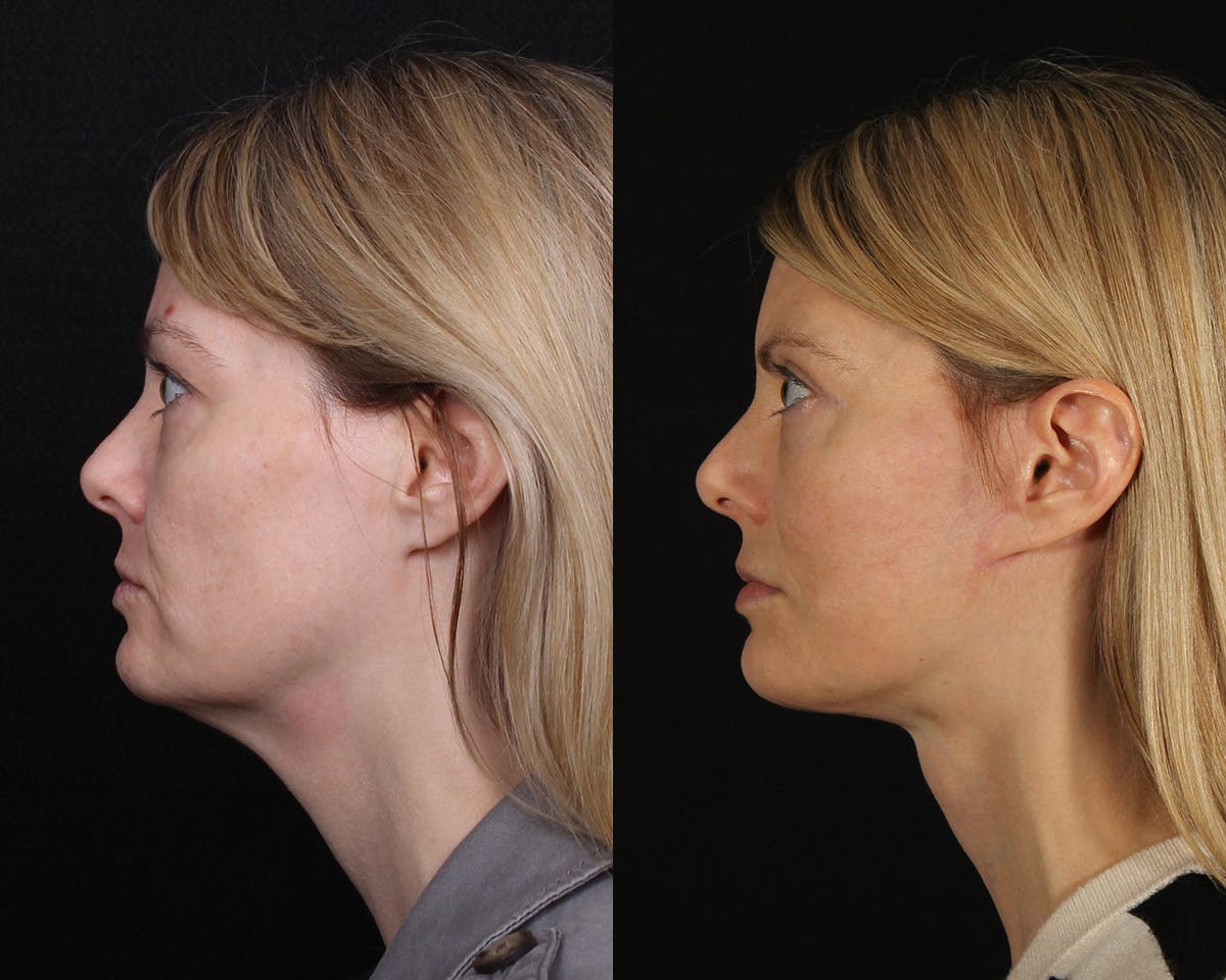 Face & Neck Lift Before & After Gallery - Patient 154632 - Image 4