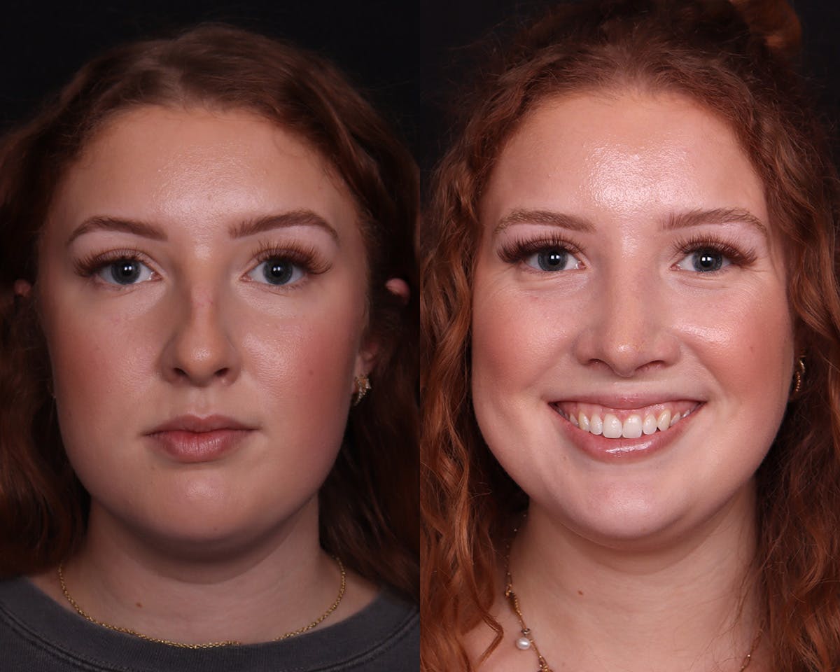 Rhinoplasty Female Before & After Gallery - Patient 274937 - Image 3