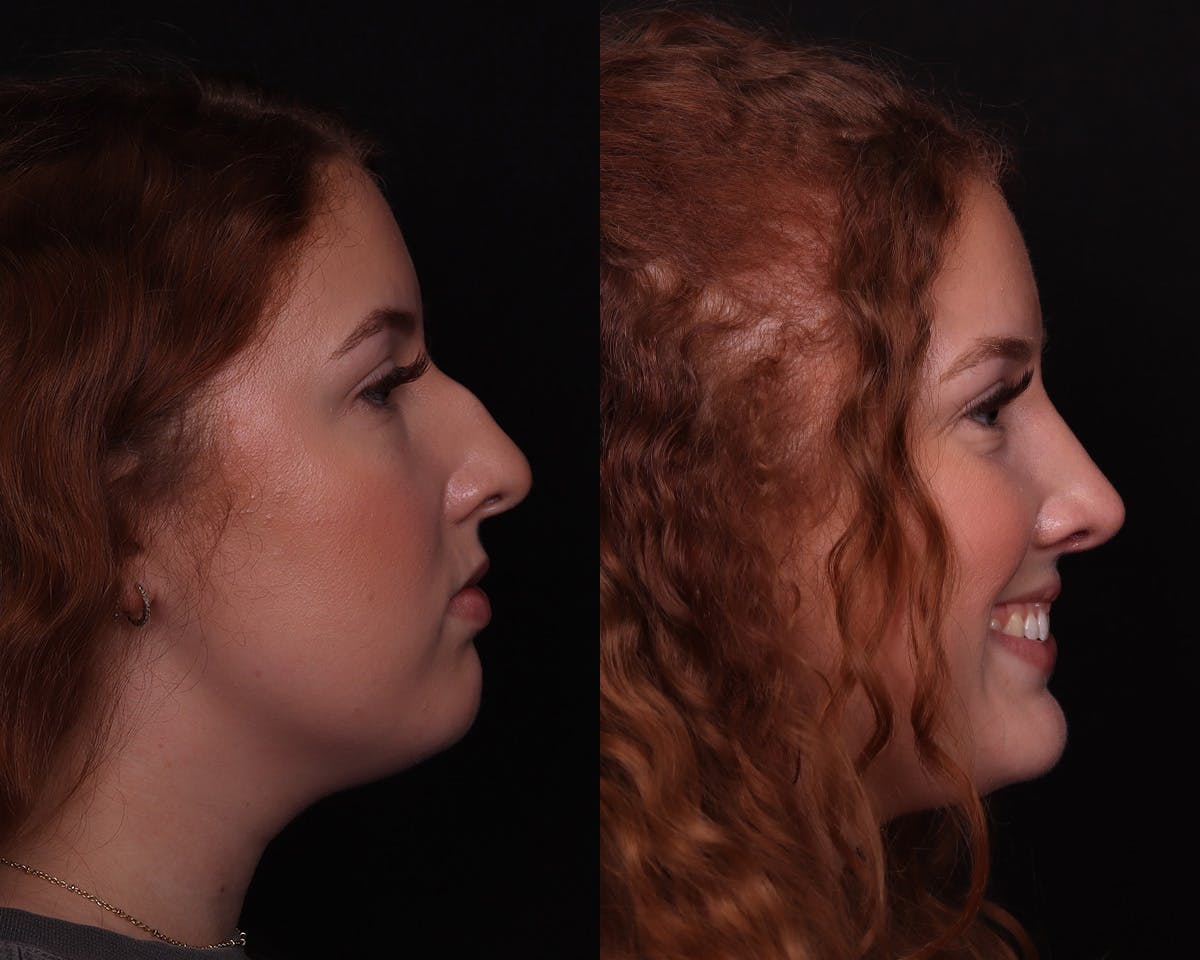 Rhinoplasty Female Before & After Gallery - Patient 274937 - Image 5