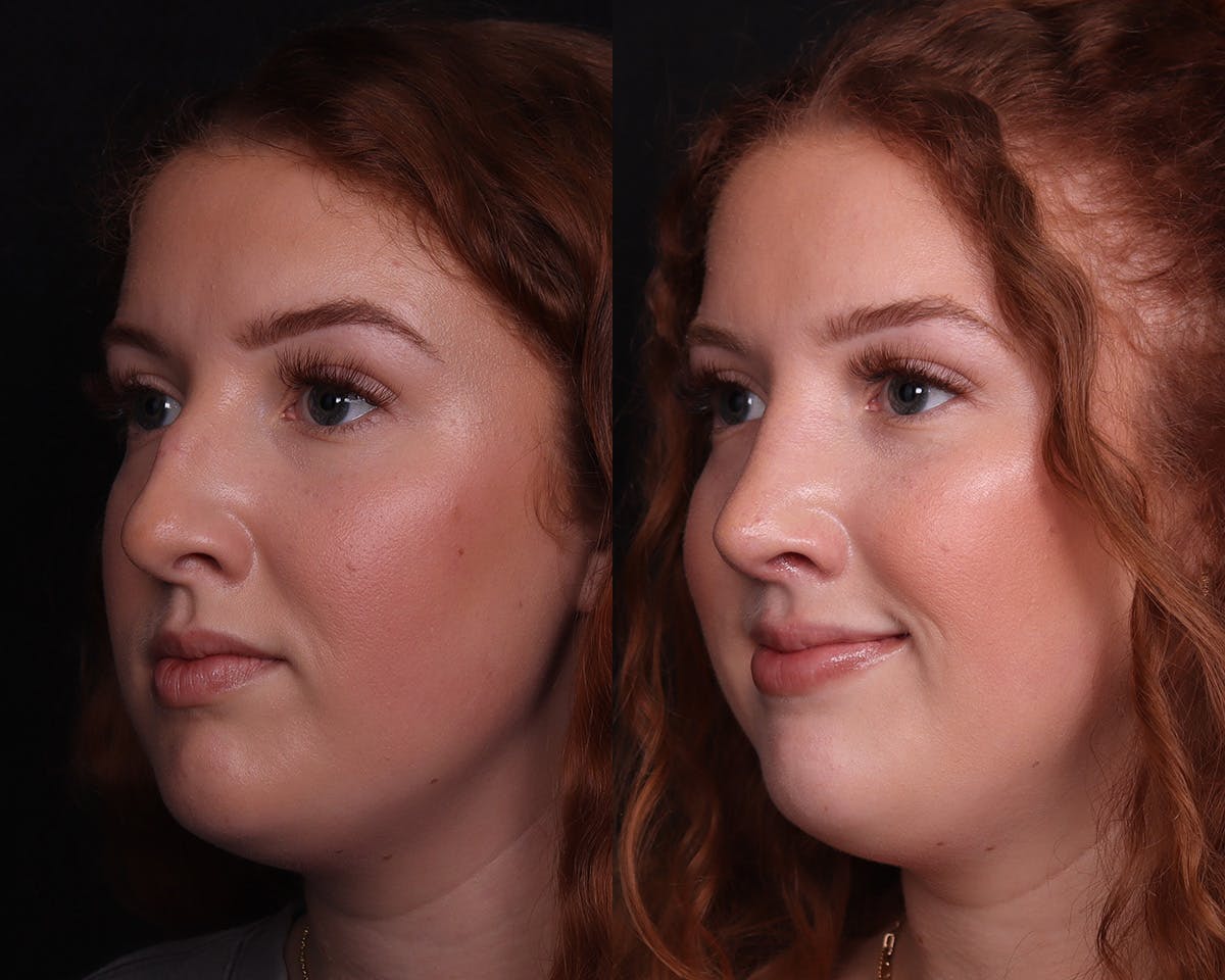 Rhinoplasty Female Before & After Gallery - Patient 274937 - Image 2