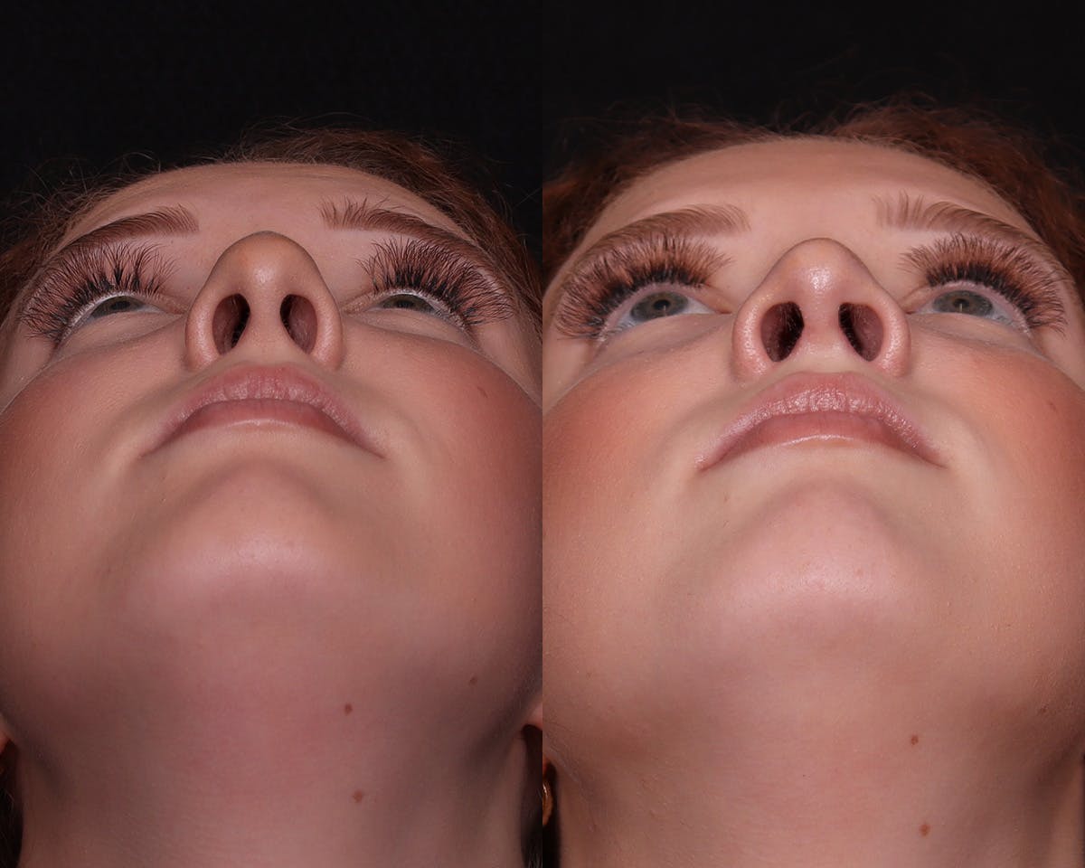 Rhinoplasty Female Before & After Gallery - Patient 274937 - Image 4