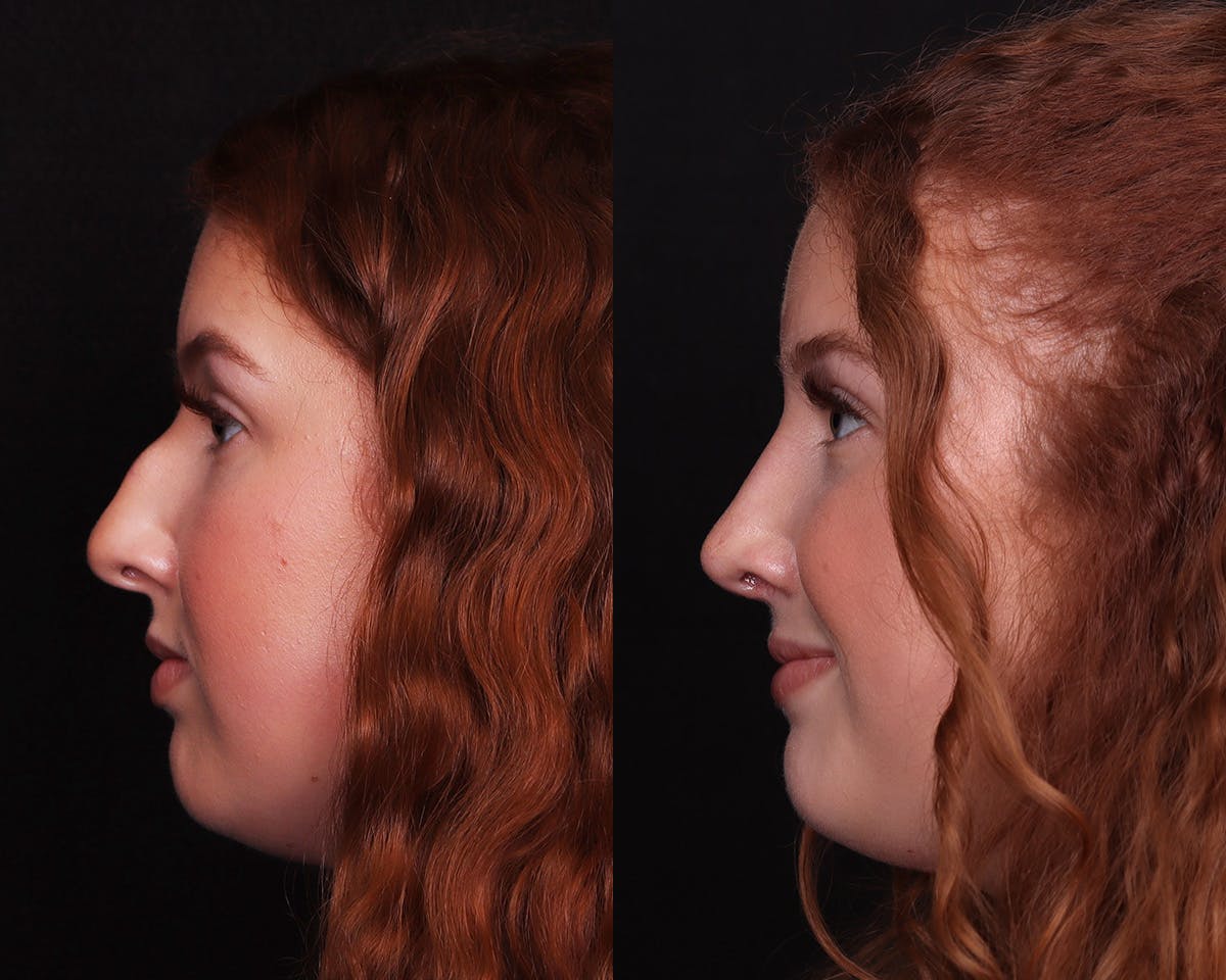 Rhinoplasty Female Before & After Gallery - Patient 274937 - Image 1
