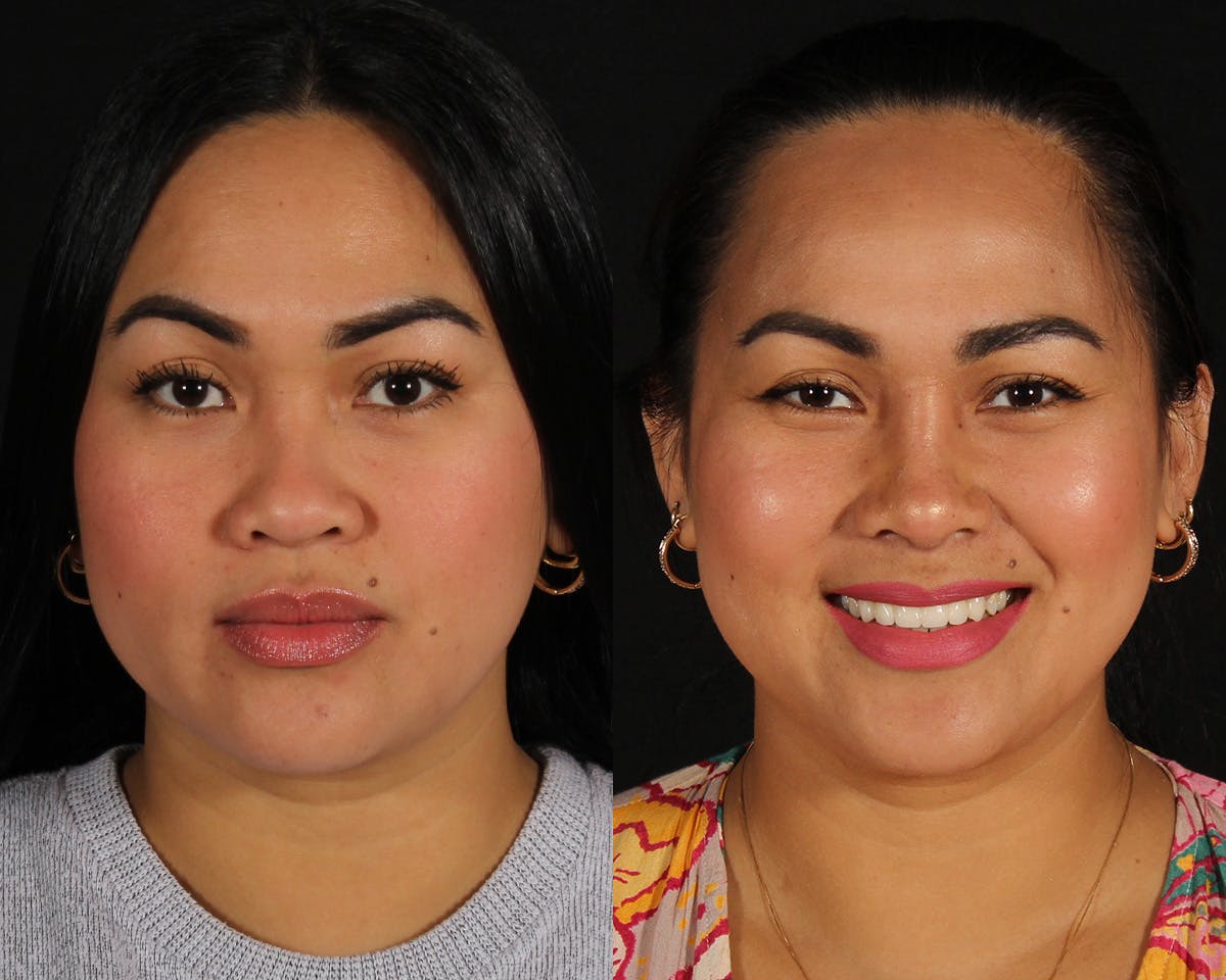 Rhinoplasty Female Before & After Gallery - Patient 865866 - Image 3