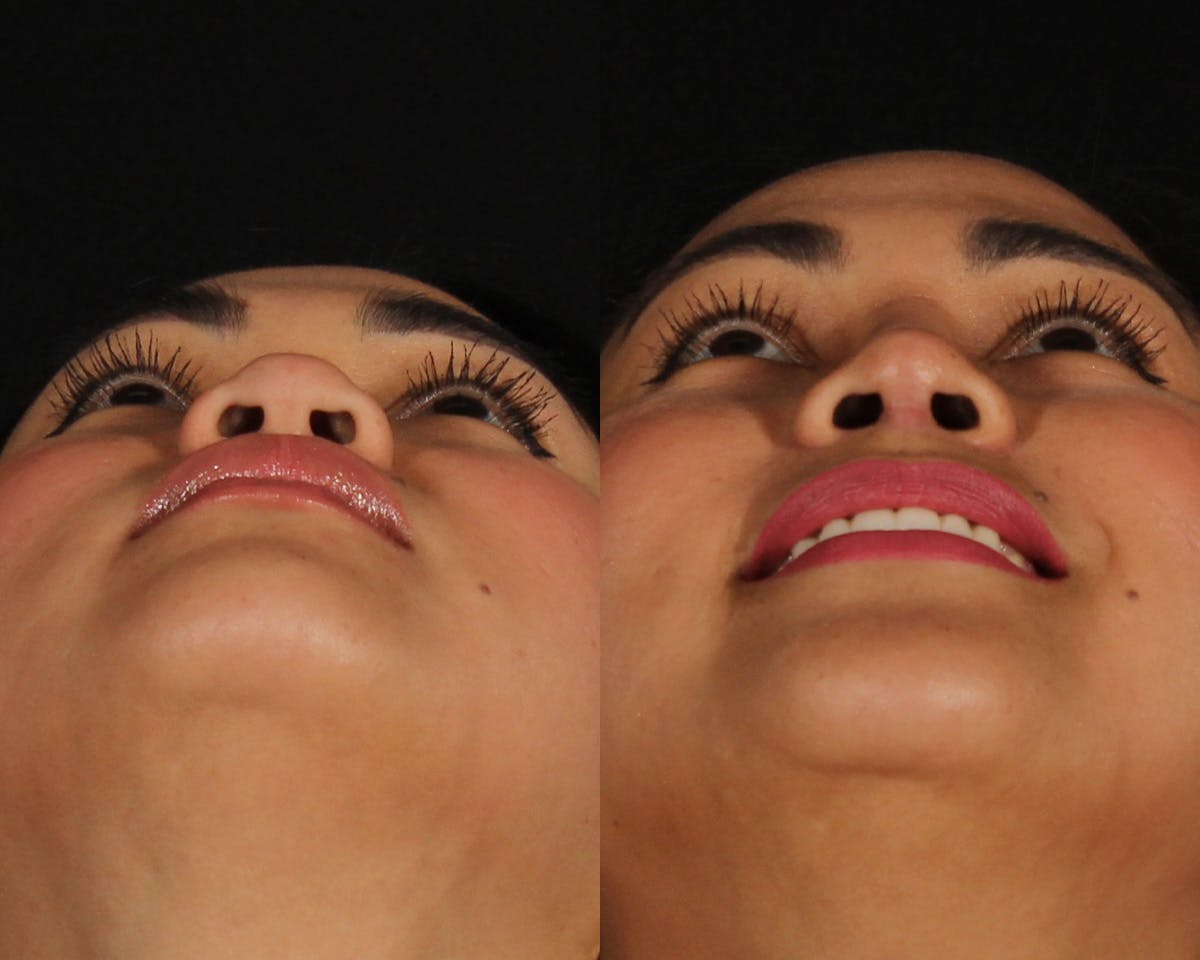 Rhinoplasty Female Before & After Gallery - Patient 865866 - Image 4