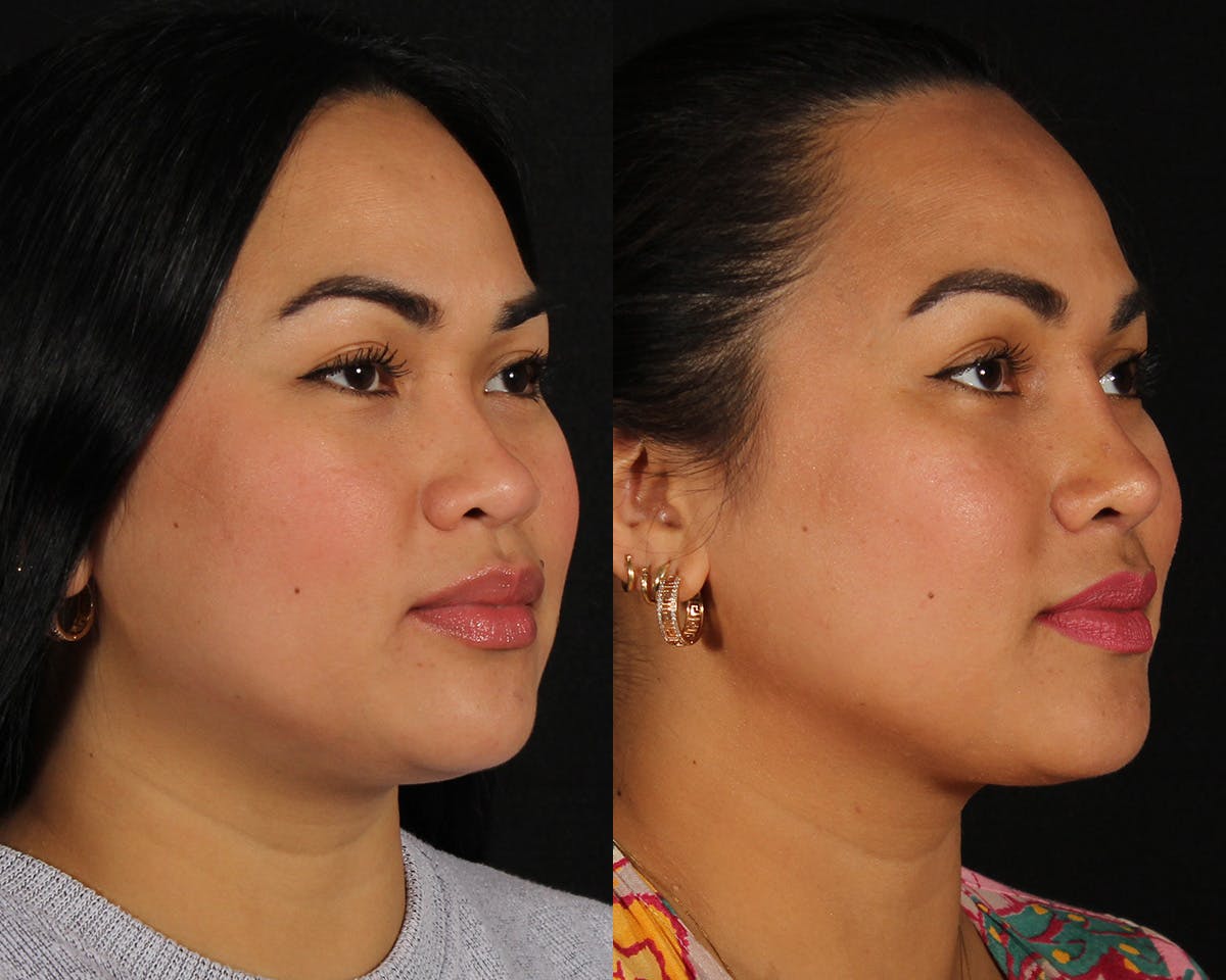 Rhinoplasty Female Before & After Gallery - Patient 865866 - Image 5