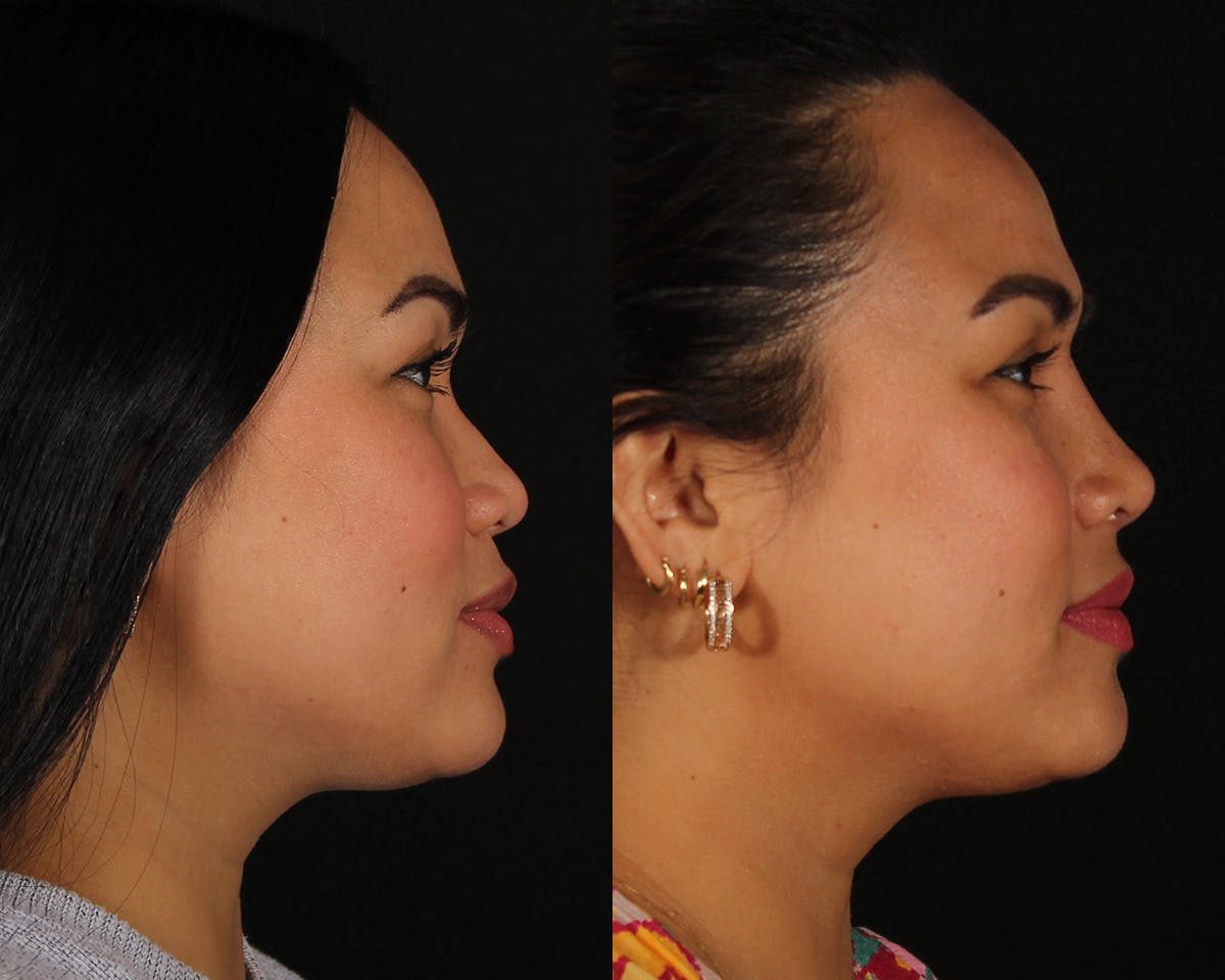 Rhinoplasty Female Before & After Gallery - Patient 865866 - Image 6