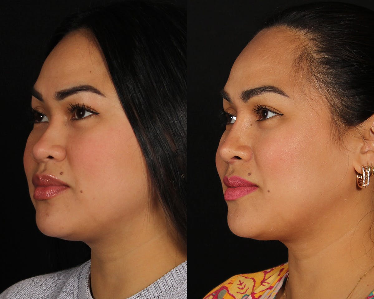 Rhinoplasty Female Before & After Gallery - Patient 865866 - Image 2