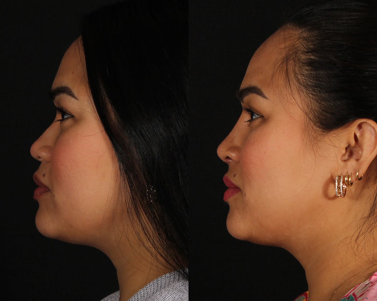 Rhinoplasty Female Before & After Gallery - Patient 865866 - Image 1