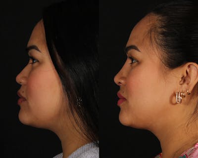 Rhinoplasty Female Before & After Gallery - Patient 865866 - Image 1