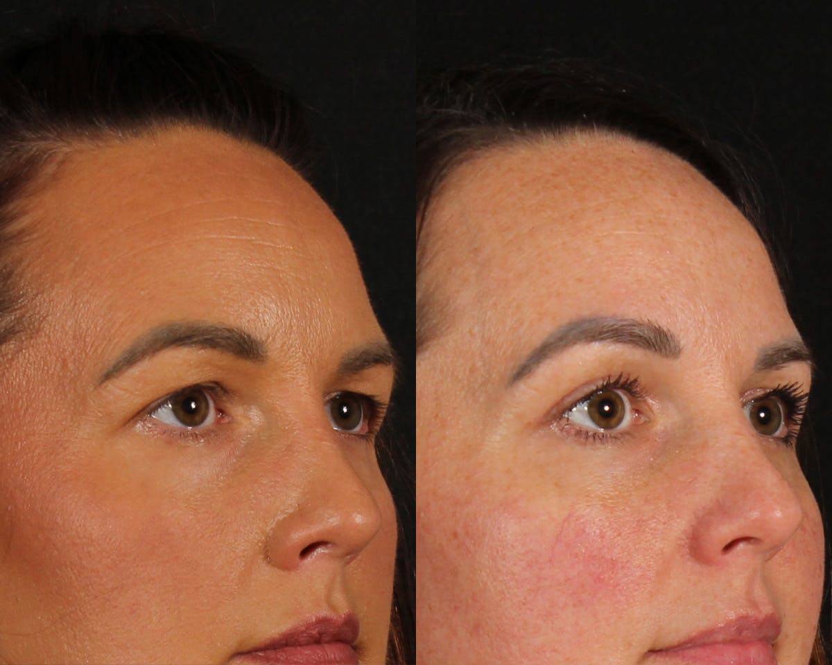 Blepharoplasty Before & After Gallery - Patient 193695 - Image 1