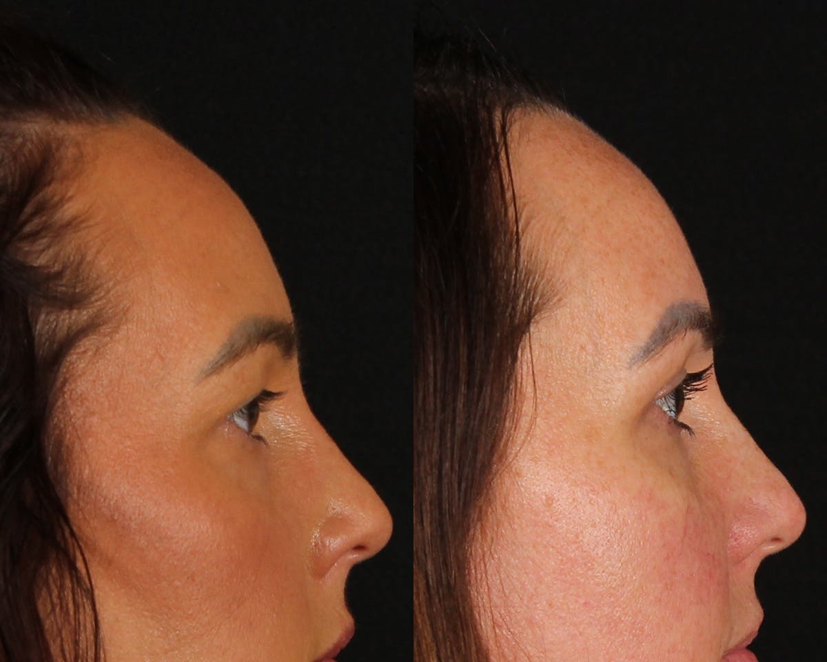 Blepharoplasty Before & After Gallery - Patient 193695 - Image 2
