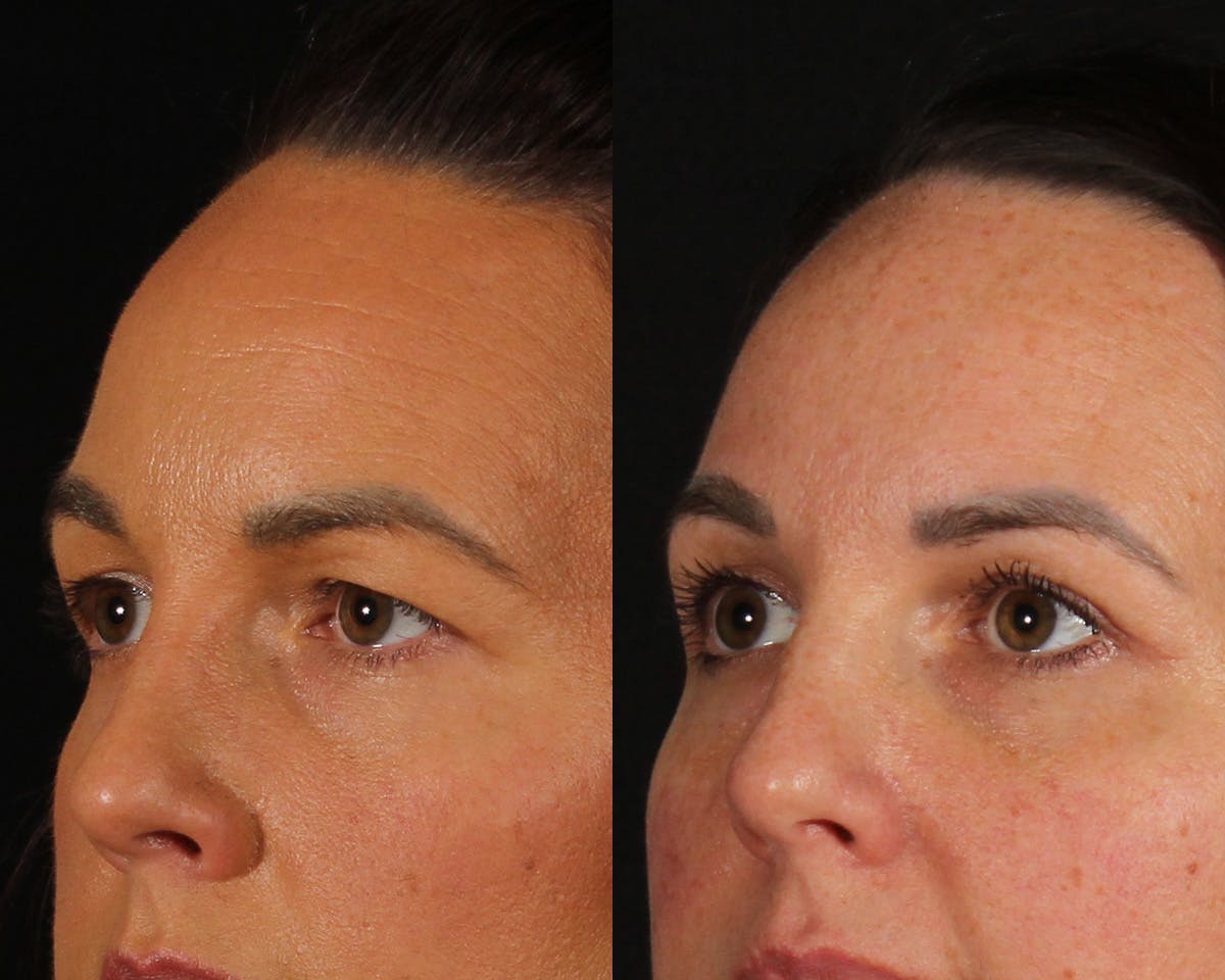 Blepharoplasty Before & After Gallery - Patient 193695 - Image 3