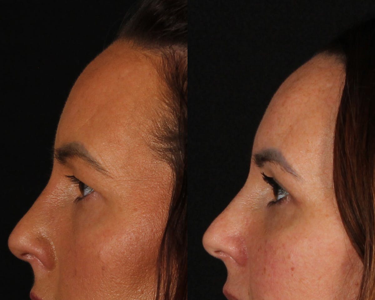 Blepharoplasty Before & After Gallery - Patient 193695 - Image 4