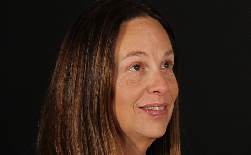 Blepharoplasty & Browlift Before & After Gallery - Patient 224767 - Image 4