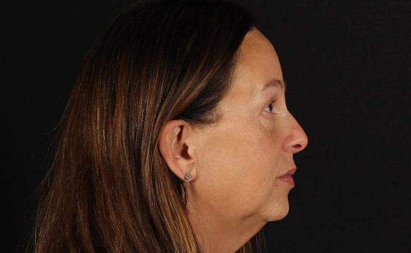 Blepharoplasty & Browlift Before & After Gallery - Patient 224767 - Image 6