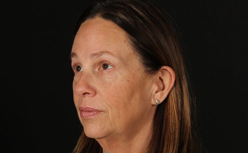Blepharoplasty & Browlift Before & After Gallery - Patient 224767 - Image 8
