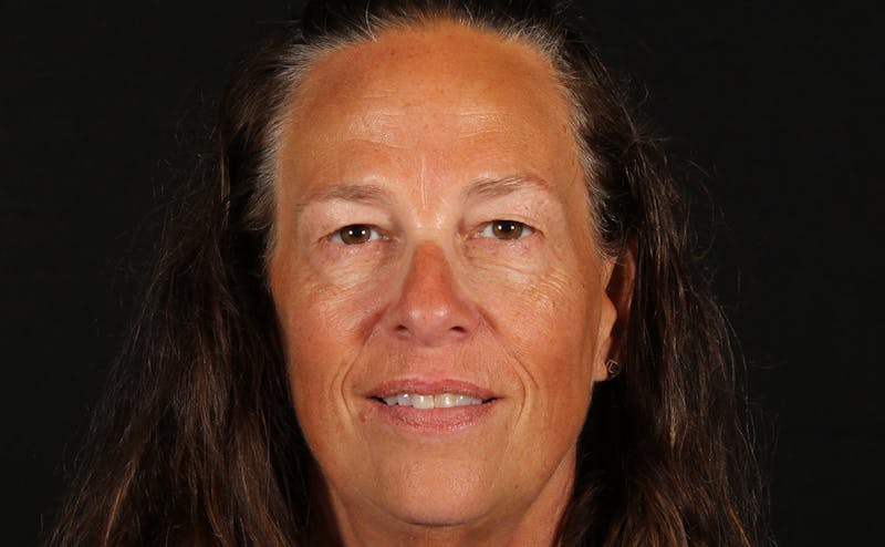 Blepharoplasty & Browlift Before & After Gallery - Patient 224767 - Image 1