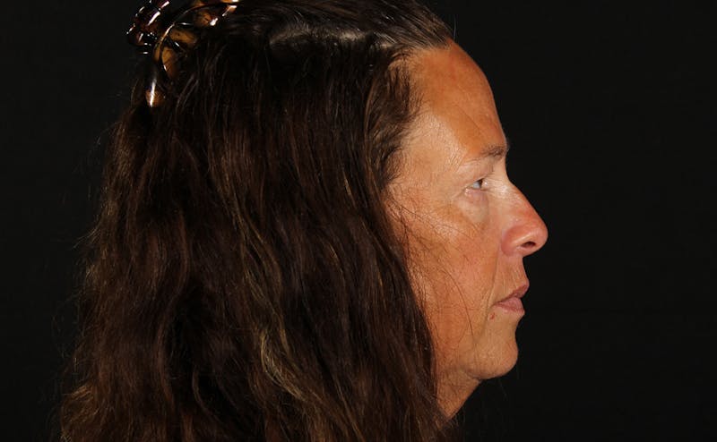 Blepharoplasty & Browlift Before & After Gallery - Patient 224767 - Image 5
